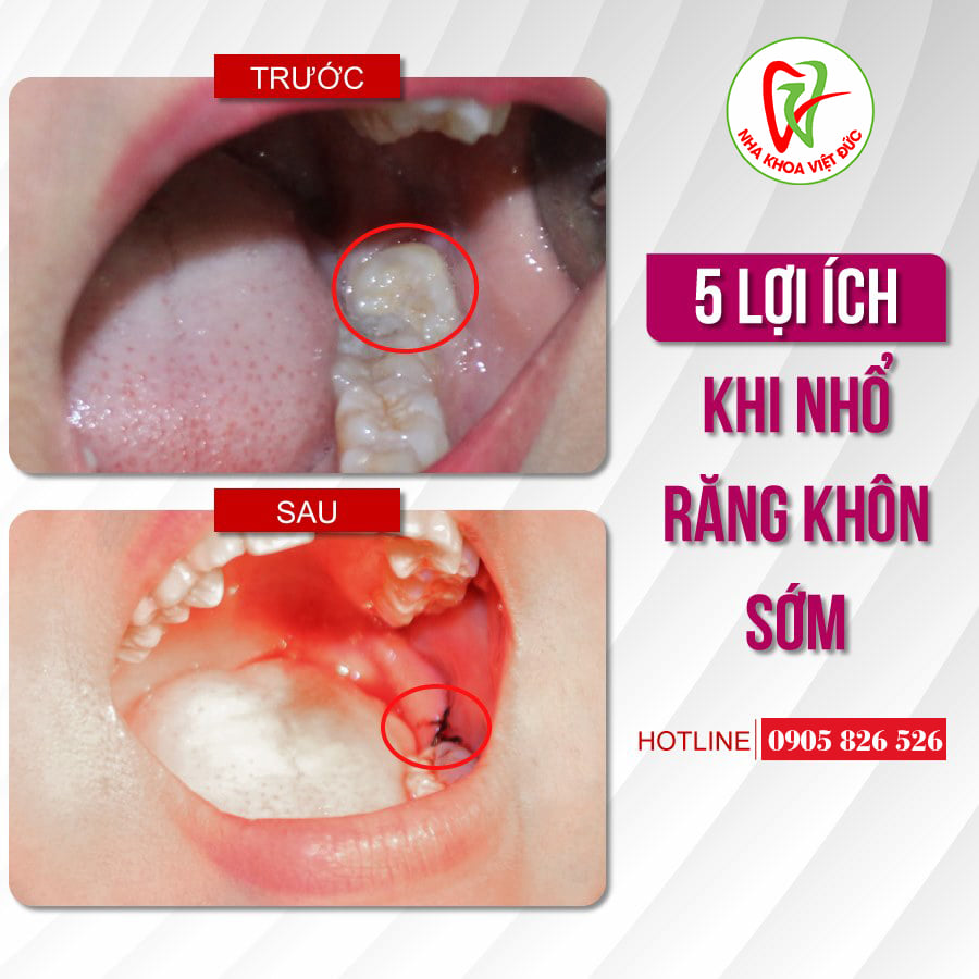  5 LỢI ÍCH KHI NHỔ RĂNG KHÔN SỚM