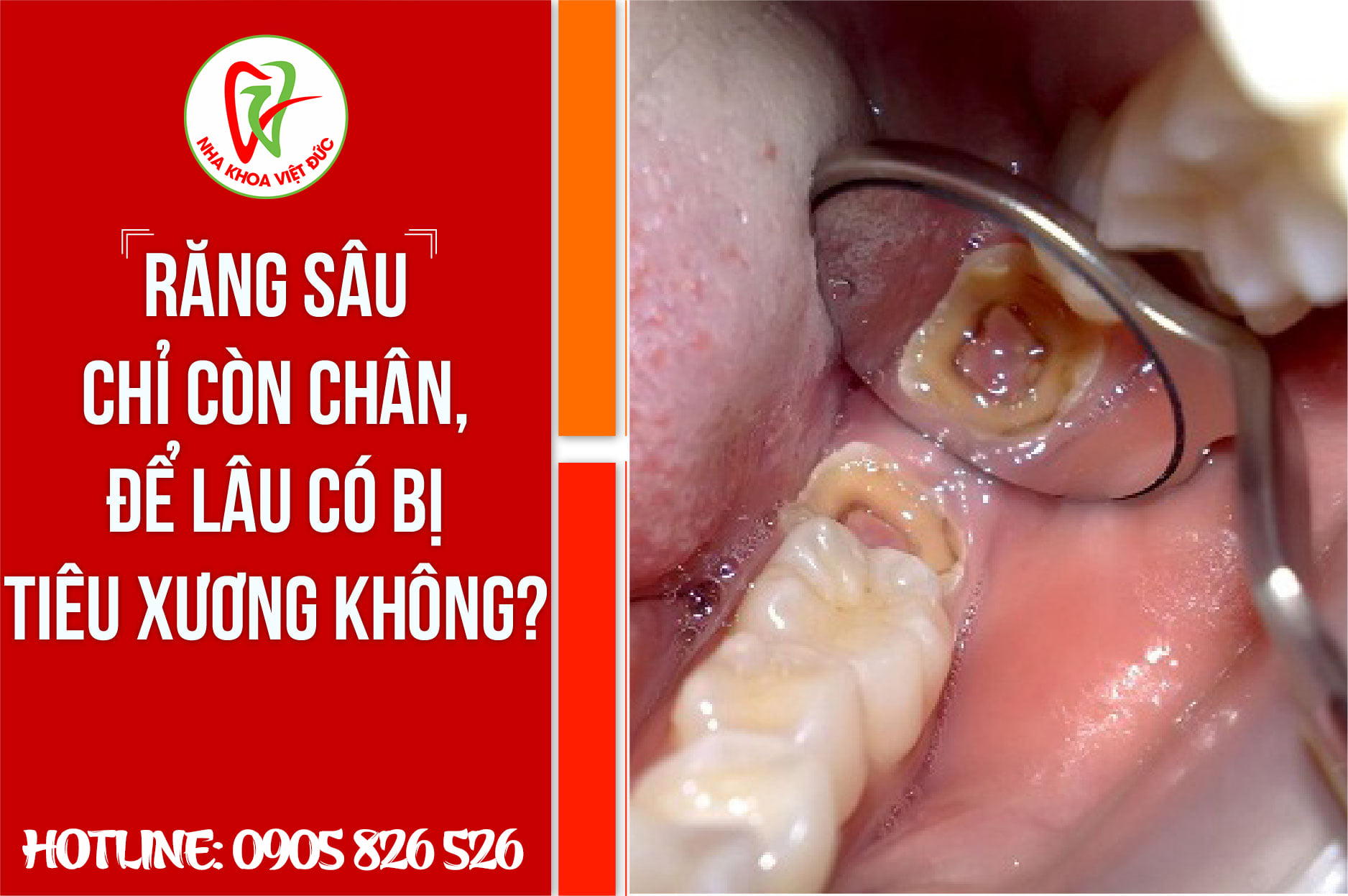 RĂNG SÂU CHỈ CÒN CHÂN, ĐỂ LÂU CÓ BỊ TIÊU XƯƠNG Ổ RĂNG KHÔNG? 