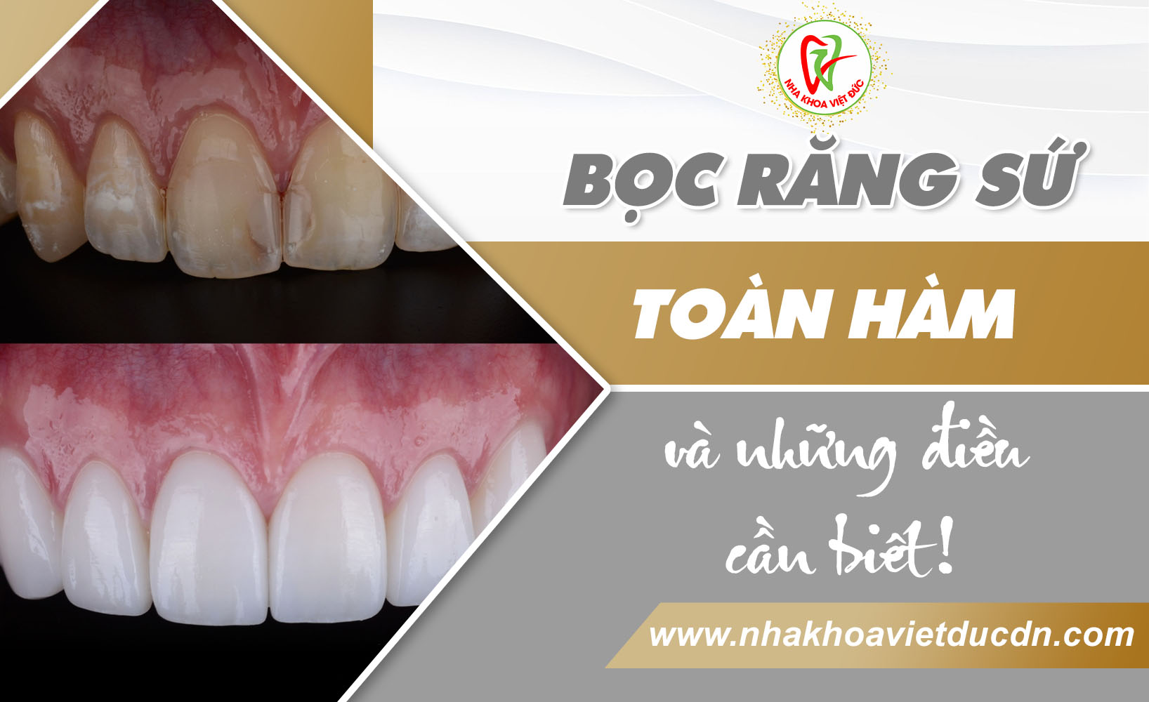 BỌC RĂNG SỨ TOÀN HÀM VÀ NHỮNG ĐIỀU CẦN BIẾT