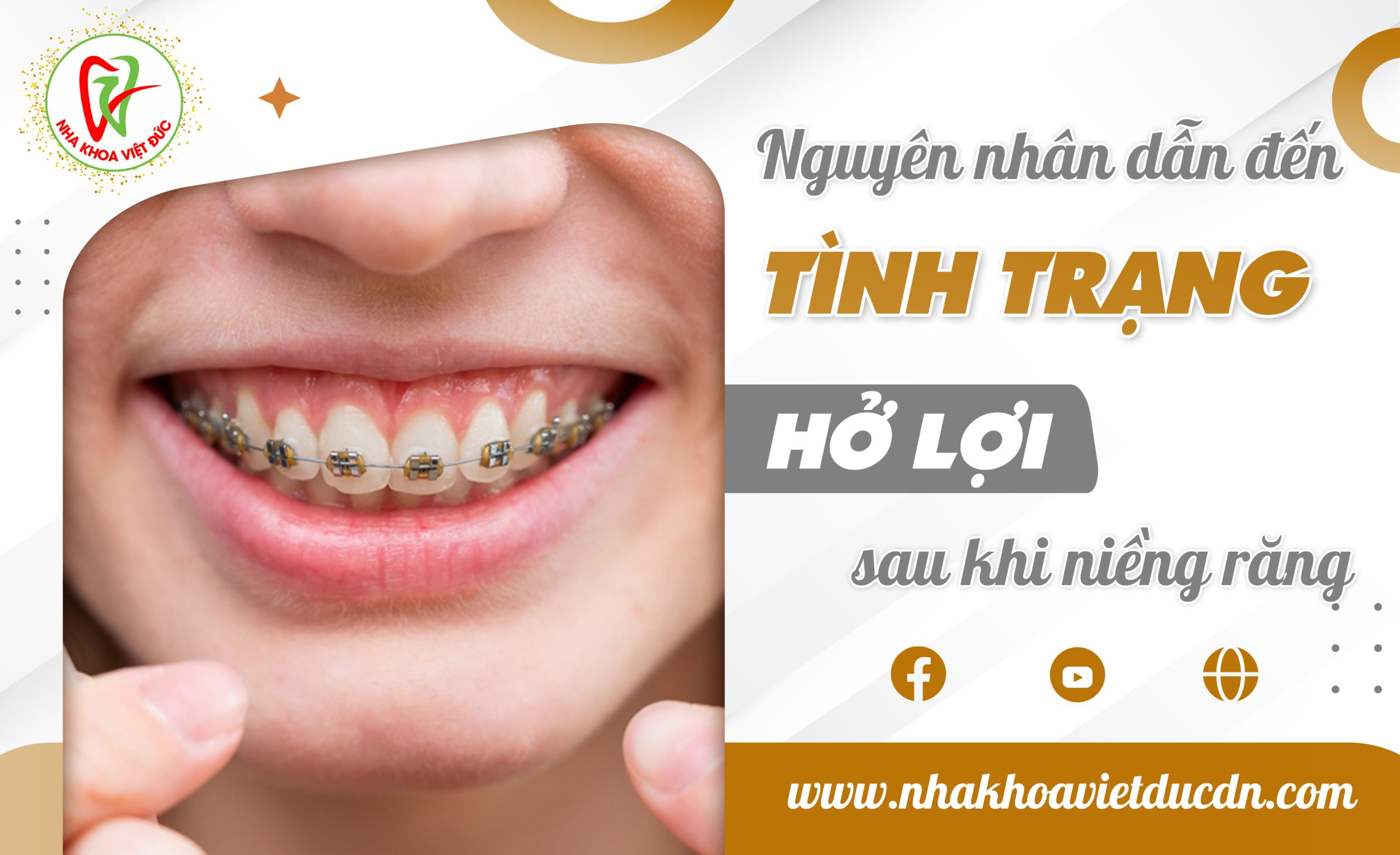 NGUYÊN NHÂN DẪN ĐẾN TÌNH TRẠNG HỞ LỢI SAU KHI NIỀNG RĂNG