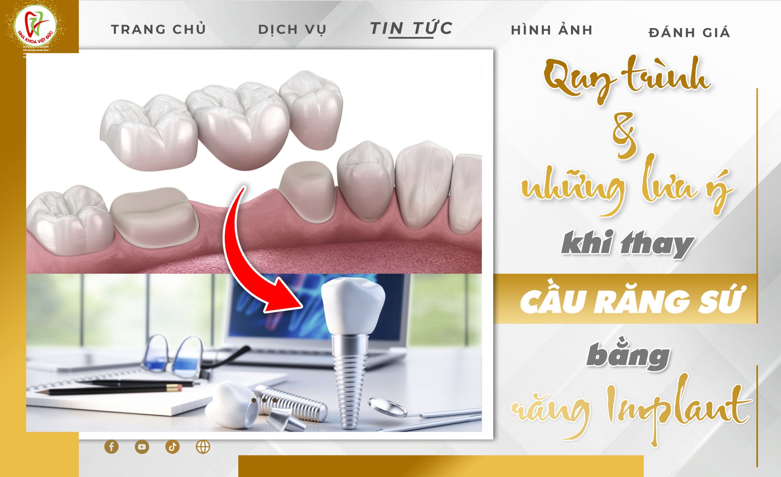 QUY TRÌNH VÀ NHỮNG LƯU Ý KHI THAY CẦU RĂNG SỨ BẰNG RĂNG IMPLANT