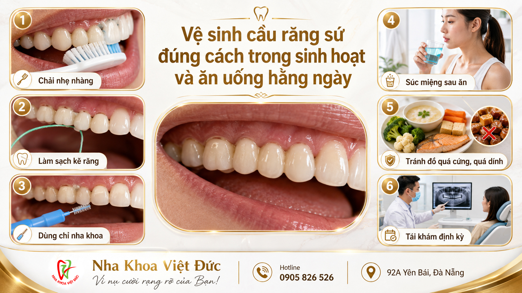 Cách vệ sinh dưới cầu răng sứ và bảo vệ răng trụ
